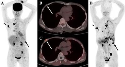 Applications of FAPI PET/CT in the diagnosis and treatment of breast and the most common gynecologic malignancies: a literature review